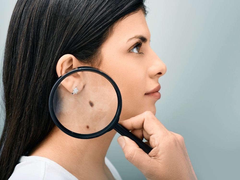 Melanoma-cutaneo-cos-e-e-come-fare-prevenzione-Consigli-per-la-salute-Centro-medico-Fleming.jpg